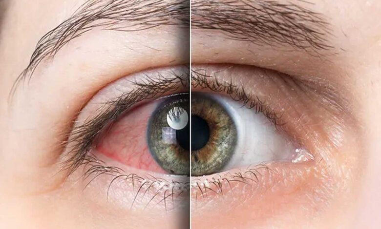هشدار متخصصان چشم پزشکی نسبت به شیوع عارضه خشکی چشم