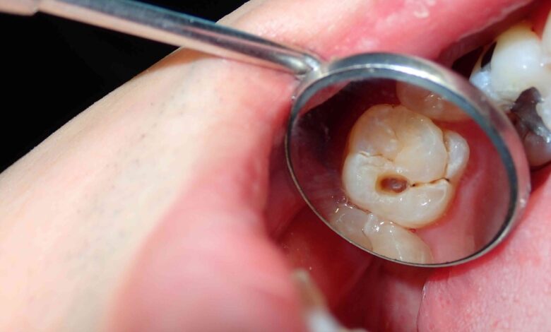 پوسیدگی دندان نوعی بیماری است