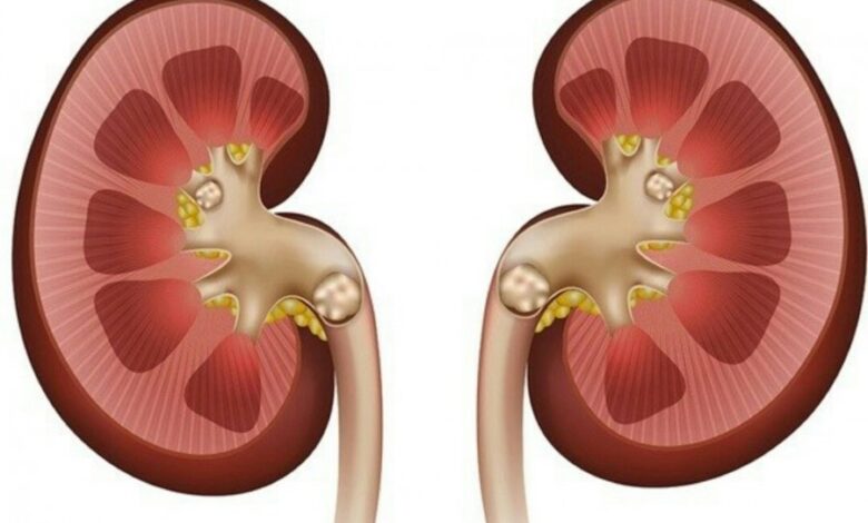 این مواد غذایی باعث ایجاد سنگ کلیه می شود