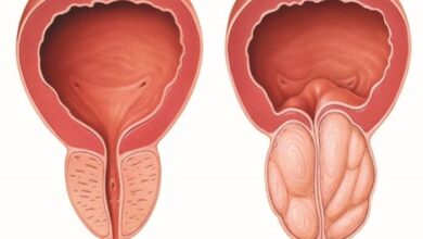 علائم اولیه بزرگ شدن پروستات چیست؟