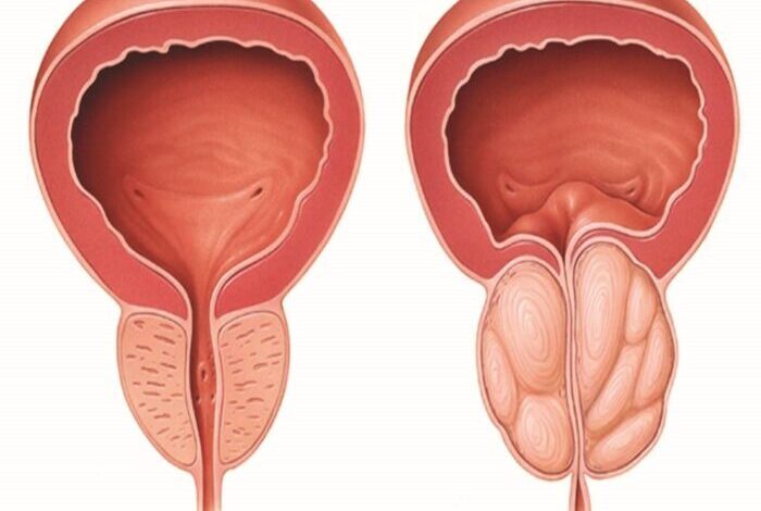 علائم اولیه بزرگ شدن پروستات چیست؟