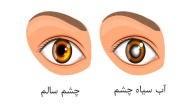 گلوکوم یا آب سیاه چشم چیست و چه علائمی دارد؟