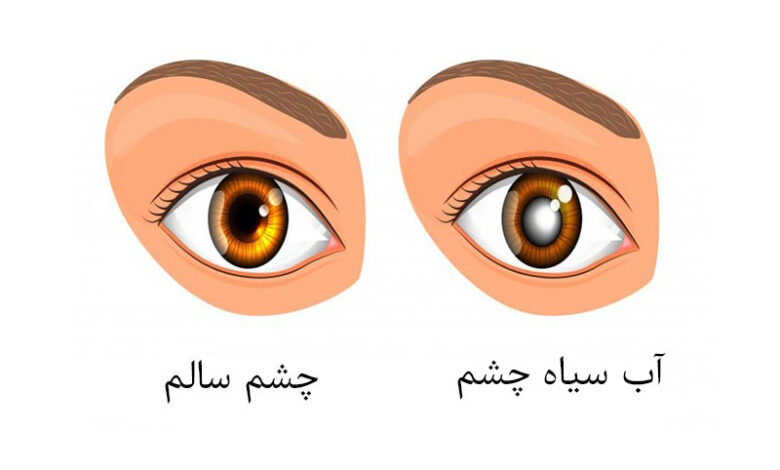 گلوکوم یا آب سیاه چشم چیست و چه علائمی دارد؟