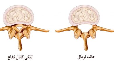 علائم تنگی کانال نخاعی گردن چیست؟