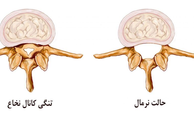 علائم تنگی کانال نخاعی گردن چیست؟