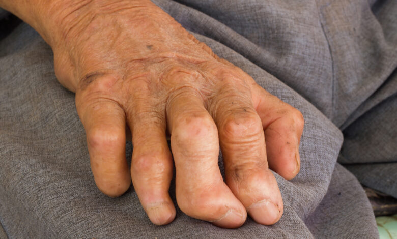 آگاهی رسانی برای پیشگیری از جذام