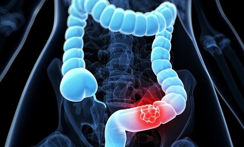 بعد از 50 سالگی غربالگری سرطان روده بزرگ را جدی بگیرید