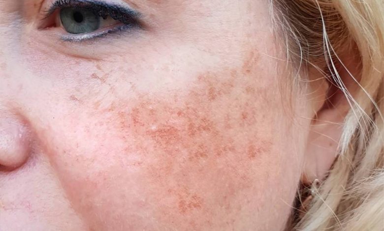 لک قهوه ای صورت