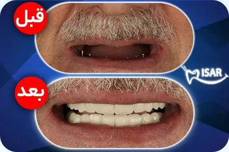 ايمپلنت و ارتودنسي و كامپوزيت دندان