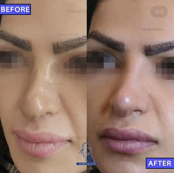 فرم دادن بینی بدون جراحی با تزریق ژل