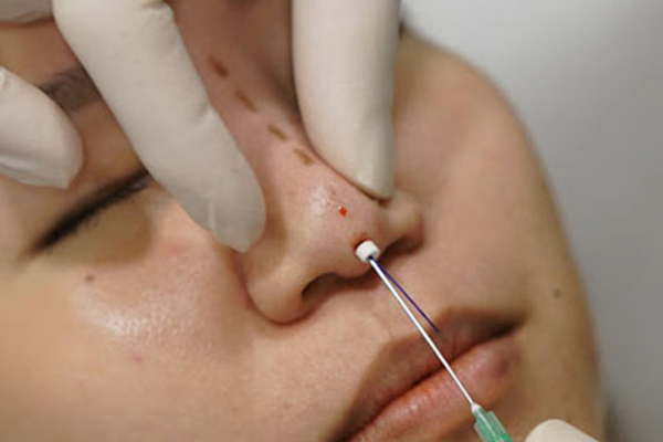 کوچک کردن بینی با نخ