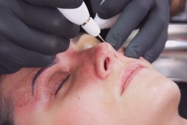 فرم دهی بینی بدون جراحی با پلاسما جت (پلکسر)