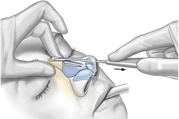  فرم دهی بینی بدون جراحی با سوهان کشیدن