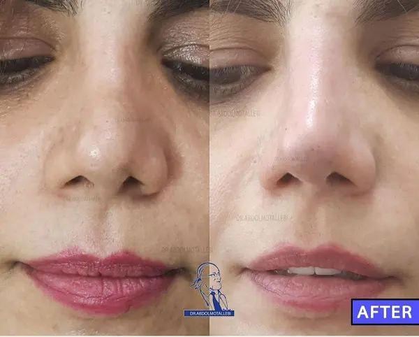 فرم دهی بینی بدون جراحی برای چه کسانی مناسب است؟