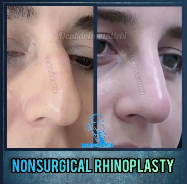 معایب فرم دهی بینی بدون جراحی