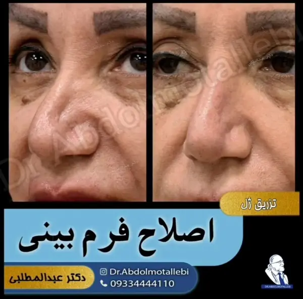 ماندگاری روش‌های فرم دهی بینی بدون جراحی